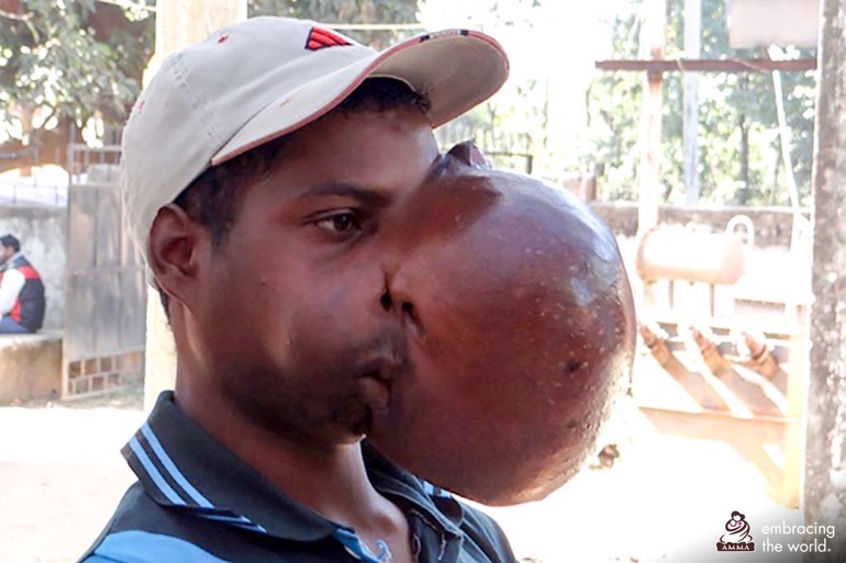 Operation de la machoire avec grosse tumeur